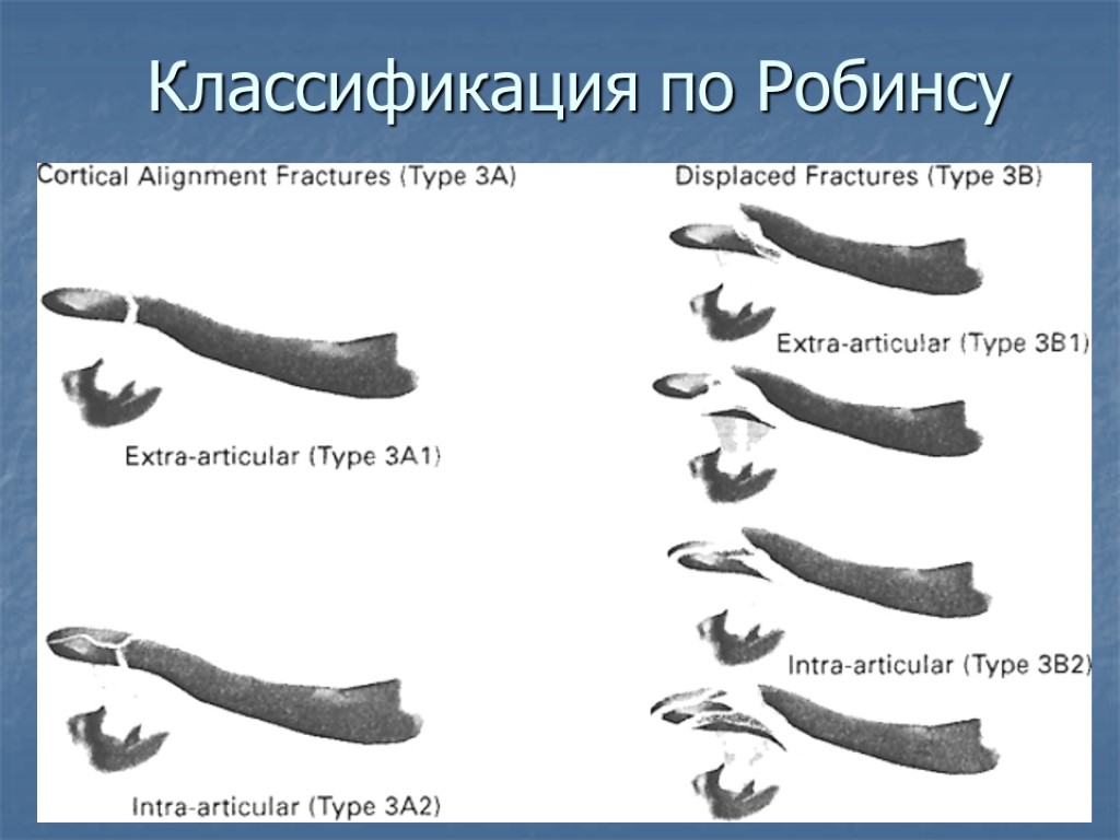 Классификация по Робинсу